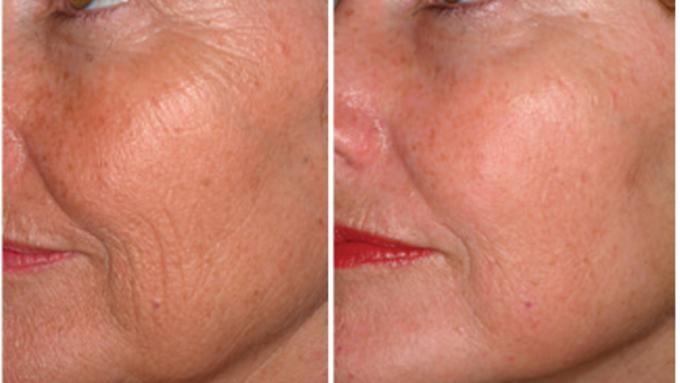 Anti-Aging Laser Treatment in Udaipur
