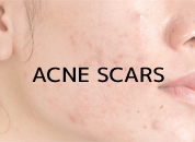 cosmetic surgery in Udaipur - acne scars treatment