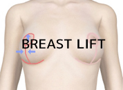 cosmetic surgery in Udaipur - breast lift