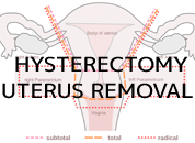 Cosmetic Surgery in Udaipur - hysterectomy uterus removal
