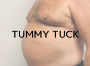 cosmetic surgery in Udaipur - Tummy tuck