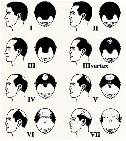  Norwood's Classification of Male Pattern Baldness (Alopecia)