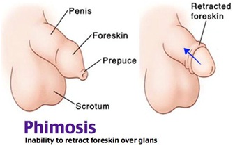 Treatment for Phimosis