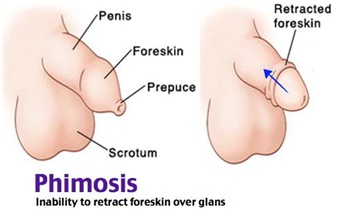 Treatment of phimosis in Tashkent