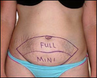 Tummy Tuck Surgery in Udaipur