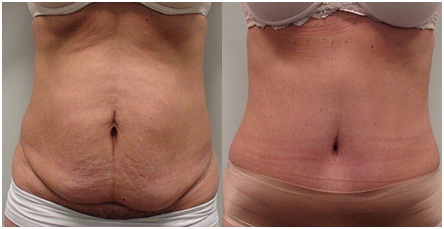 best cosmetic surgeons in udaipur - abdominoplasty