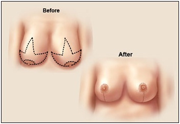 cosmetic plastic surgery in udaipur - female breast reduction