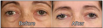 Blepharoplasty Doctor in Udaipur - upper eyelid surgery