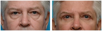 Blepharoplasty Doctor in Udaipur - Lower eyelid surgery