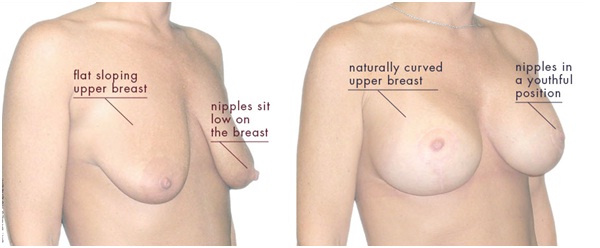 Senior Breast Lift Surgeons in udaipur