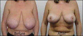Breast Reduction Surgery in Udaipur