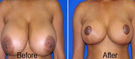 Breast Reduction Surgery in Udaipur