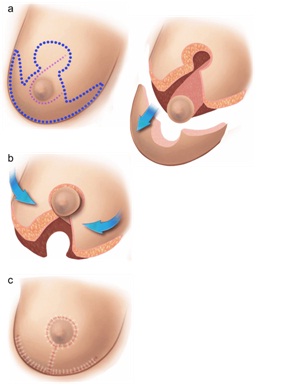 Best Breast Reduction Specialist in Udaipur