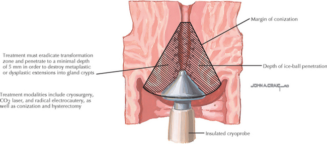 Cervix Cryo Cautery Udaipur