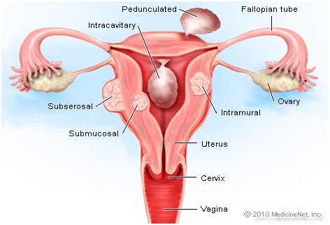 uterine fibroids treatment in Udaipur