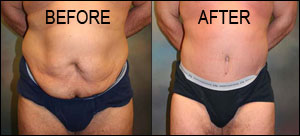 full tummy tuck surgery in udaipur
