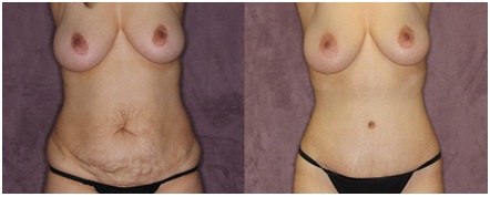 best plastic surgeon for tummy tuck in udaipur