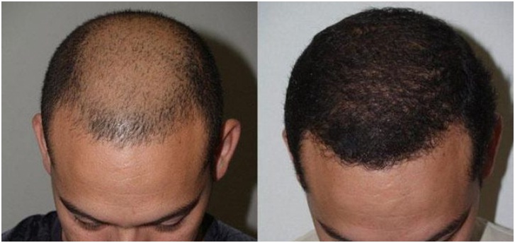 trichologist in udaipur - fue hair transplant steps