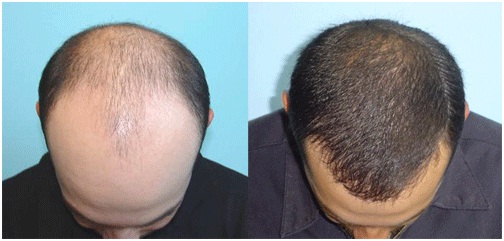 trichologist in udaipur - fue hair transplant steps