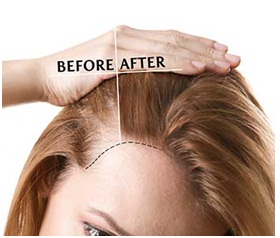 platelet rich plasma therapy for hair loss in udaipur