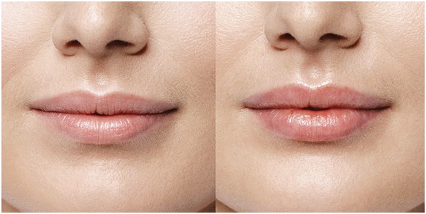 Lip Augmentation Surgery in Udaipur