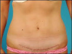 mini tummy tuck surgery in udaipur