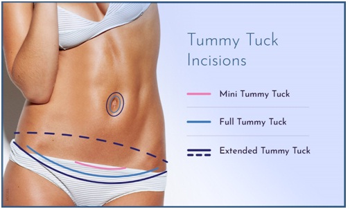  best tummy tuck surgeon in Udaipur