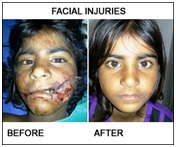 Plastic Surgery in Udaipur - face injuries & face bone fractures
