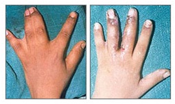 Plastic Surgery in Udaipur  - syndactyly