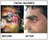 Plastic Surgery in Udaipur - face injuries & face bone fractures