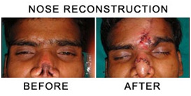 Plastic Surgery in Udaipur - reconstructive surgery