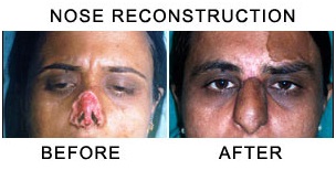 Facial Reconstruction Surgery in udaipur