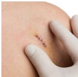Plastic Surgery in Udaipur - wound suturing