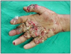 Plastic Surgery in Udaipur - hand & finger injuries