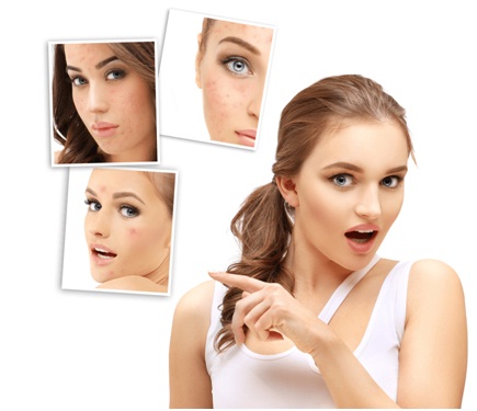 acne scars removal treatment in Udaipur