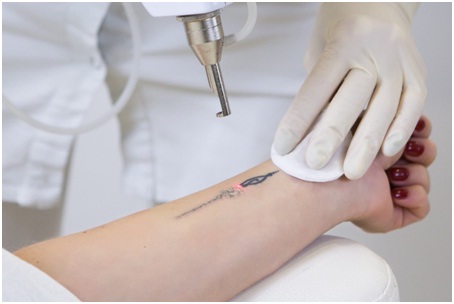 Tattoo Removal Experts in Udaipur - laser surgery