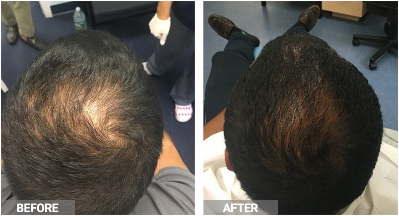 PRP Therapy For Hair Loss in Udaipur | Hair Specialist Doctor
