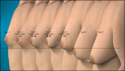 Gynecomastia types