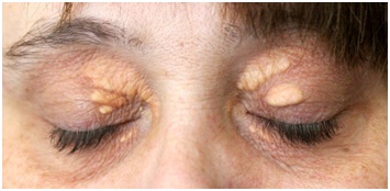 eyelid specialist in Udaipur - Xanthelasma