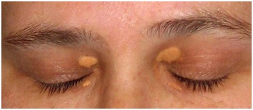 eyelid specialist in Udaipur - Xanthelasma