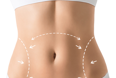 Cosmetic Surgery in udaipur - body contouring